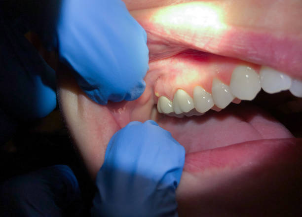 Best Emergency Dentist for Knocked-Out Tooth in Exmore, VA