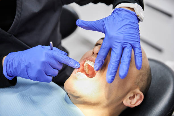 Best Emergency Dentist for Lost Fillings or Crowns in Exmore, VA
